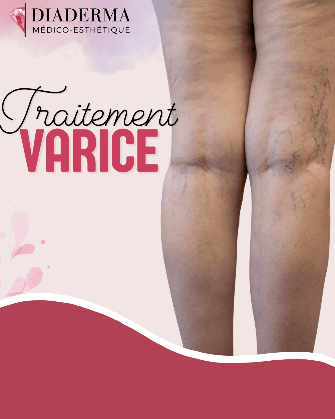 Traitements de varices