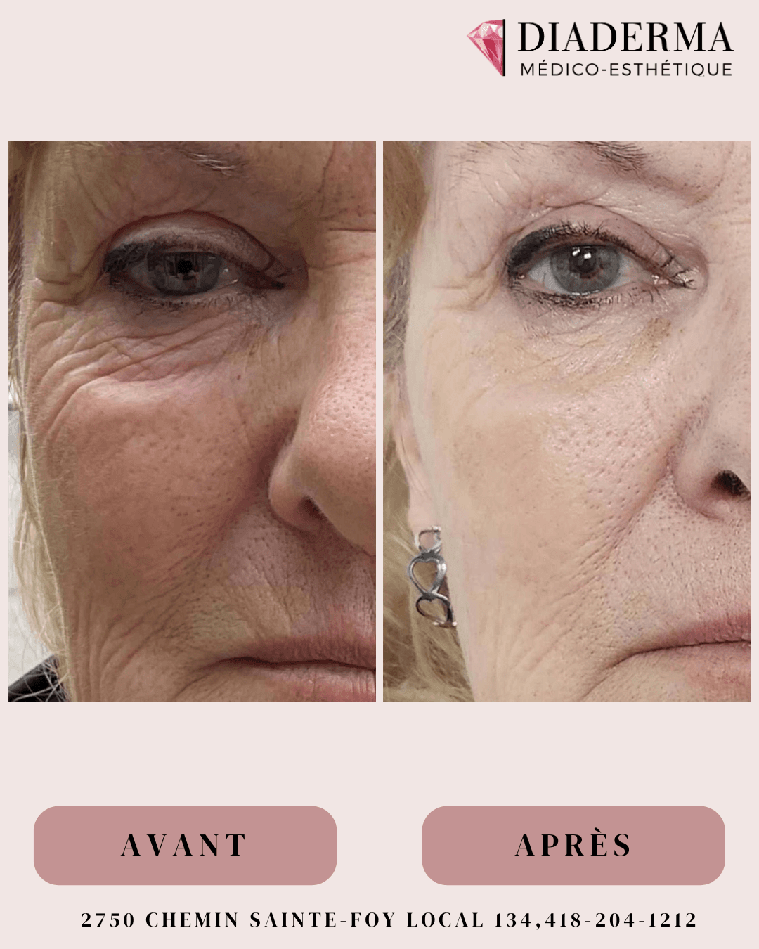 Microneedling – avant / après
