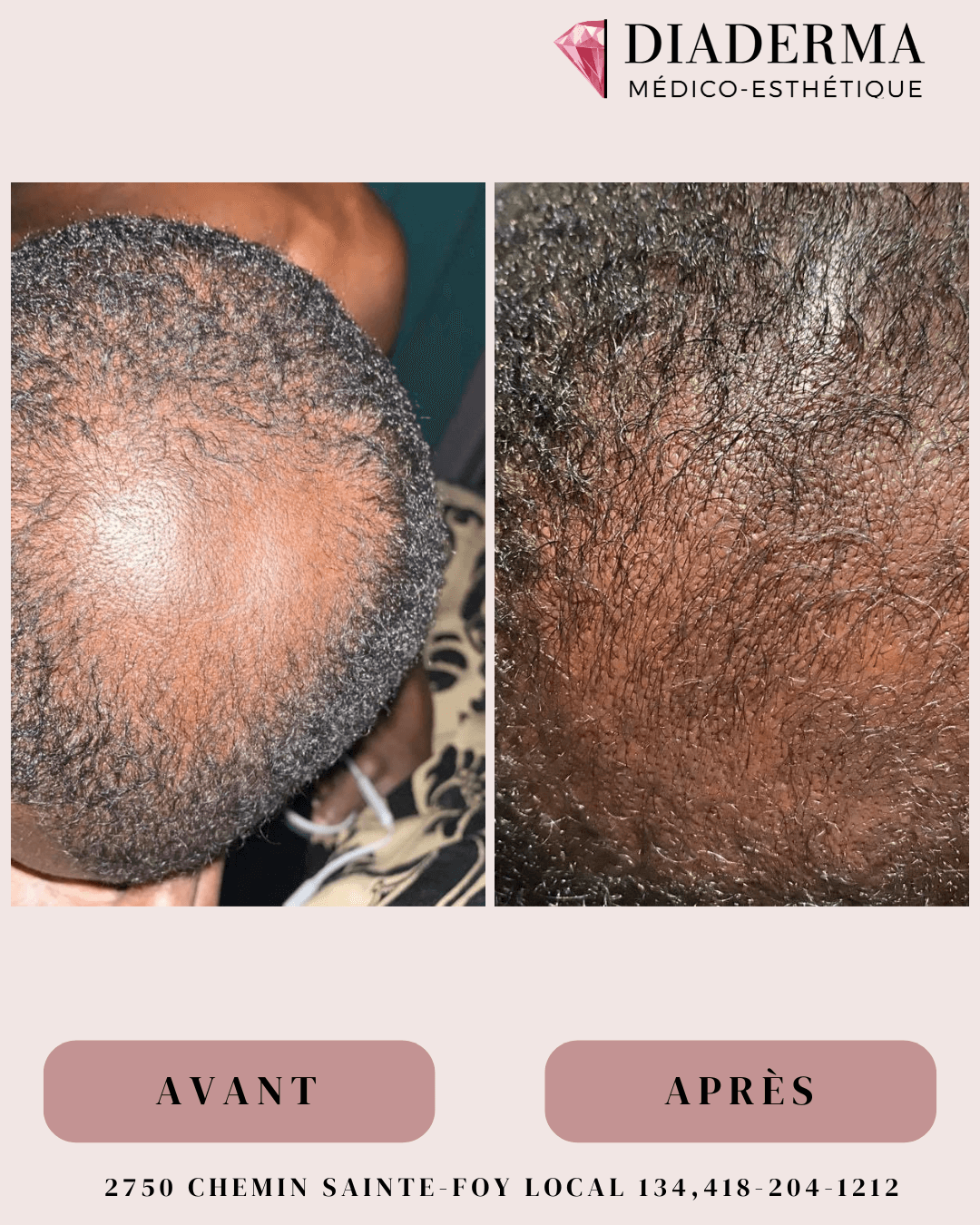 Microneedling – résultats capillaires avant / après