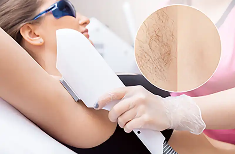 Soin peeling – vue générale