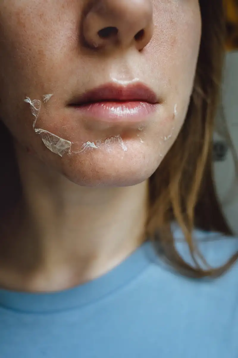 peeling